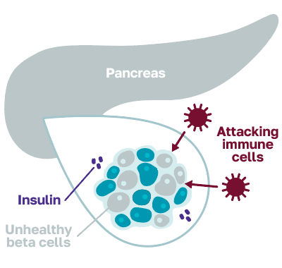 The immune system mistakenly attacks the beta cells in the pancreas.